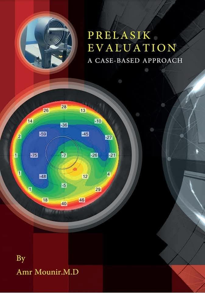 An Easy Guide To Prelasik Evaluation